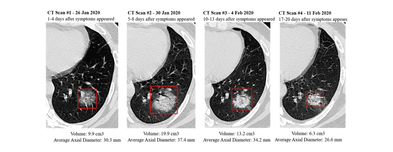 tracking the infected area among Covid-19 patients using computer vision